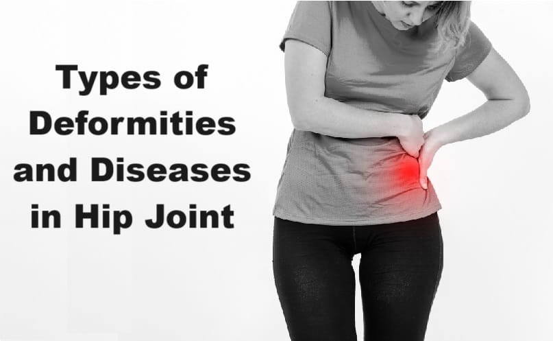 Types of Deformities and Diseases in Hip Joint